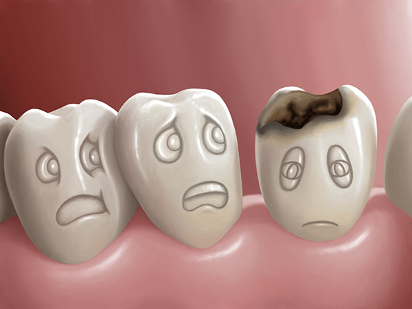 乳歯のむし歯がもたらす永久歯への悪影響