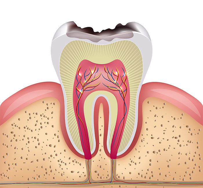 虫歯の原因について