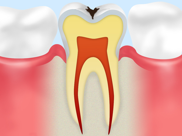 2. 歯質に小さな穴が開く